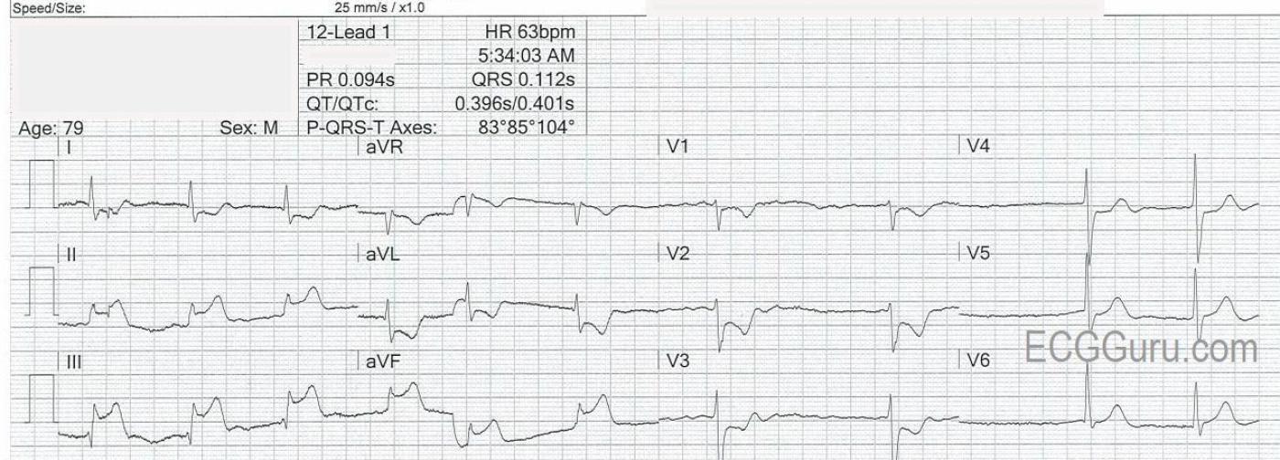 Inferior Wall Posterior Wall And Right Ventricular M I Ecg Guru